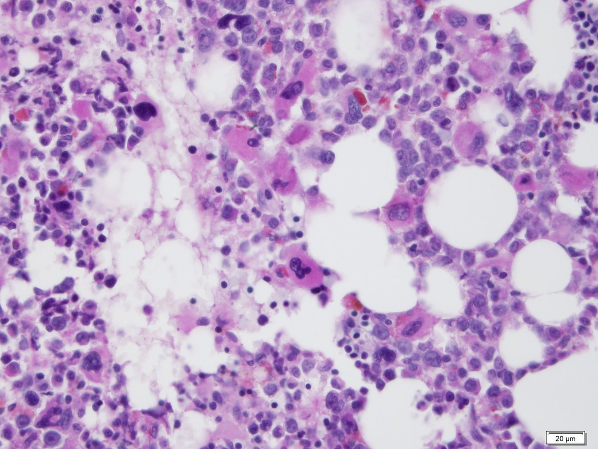 Figure 22 Recovery PAS Clot 40x